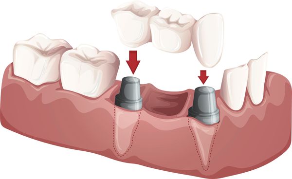 A bridge replaces missing teeth.