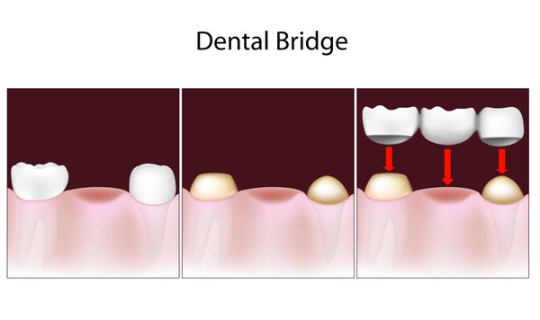 A bridge is three or more crowns placed on two or more teeth.