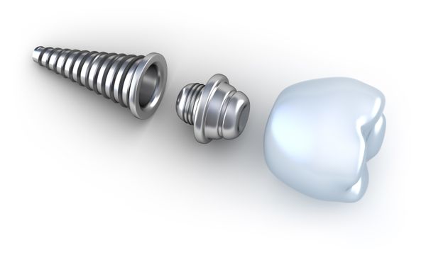 A dental implant can replace a single tooth or multiple teeth.