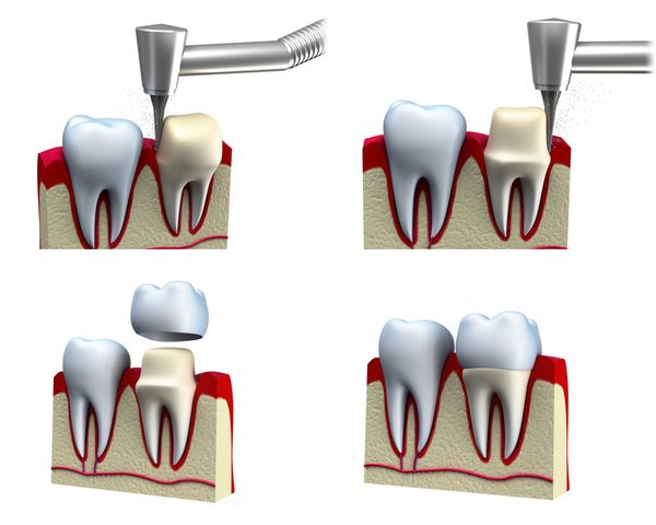 A crown (cap) is a full coverage restoration of a tooth.