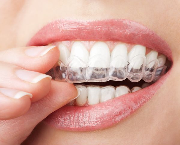 Invisalign straightens teeth without metal brackets and wires.