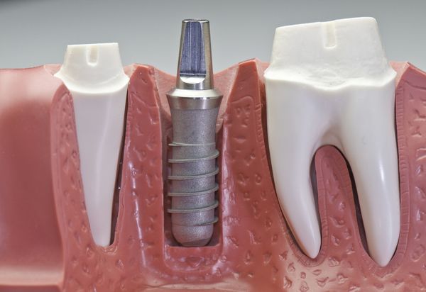 A dental implant is a replacement for the root of a tooth.