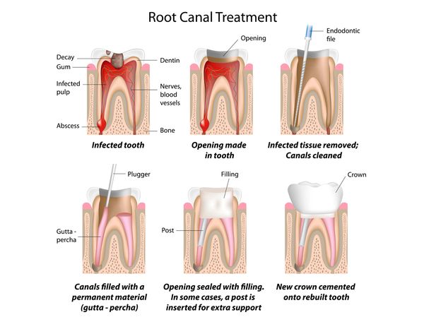 1-root-canal-therapy-1.jpg