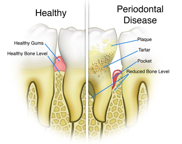 Scaling and root planing for deep cleaning of teeth and mouth.