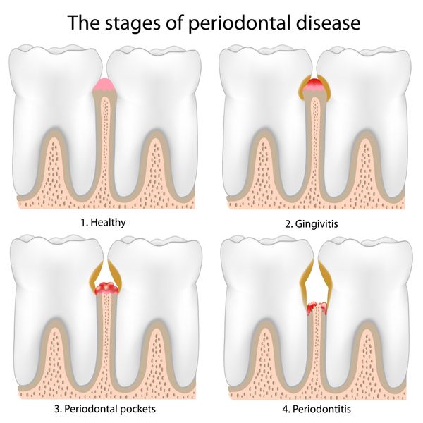 Scaling and root planing help prevent gum disease.