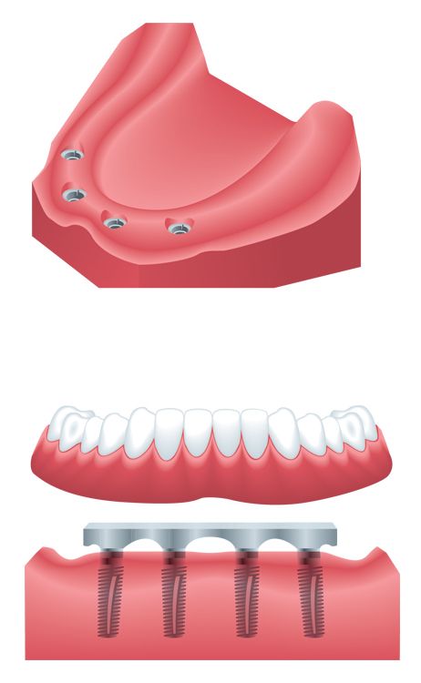 implant-supported-denture-3.jpg