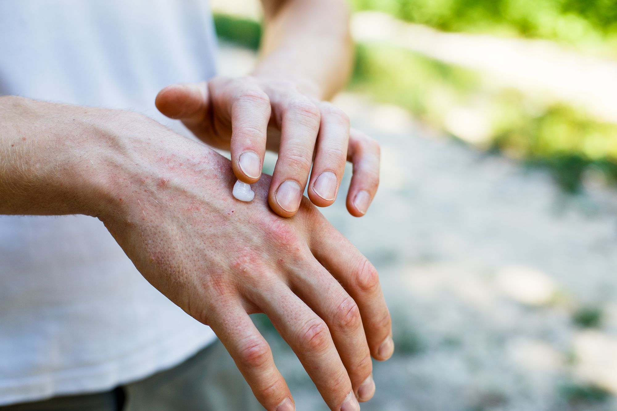Person putting on hand cream Dermatology Compounding