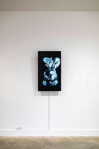 Taquicardia (Tachycardia)