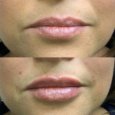 FILLERS