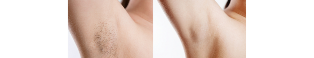 Laser Hair Removal Underarms