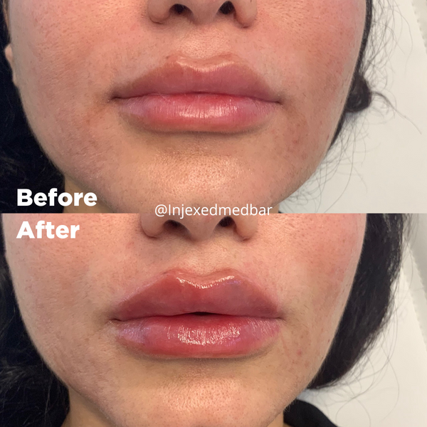 Before and After Cheek Filler