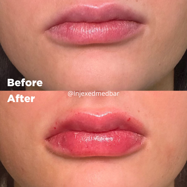 Lip Filler (5).png