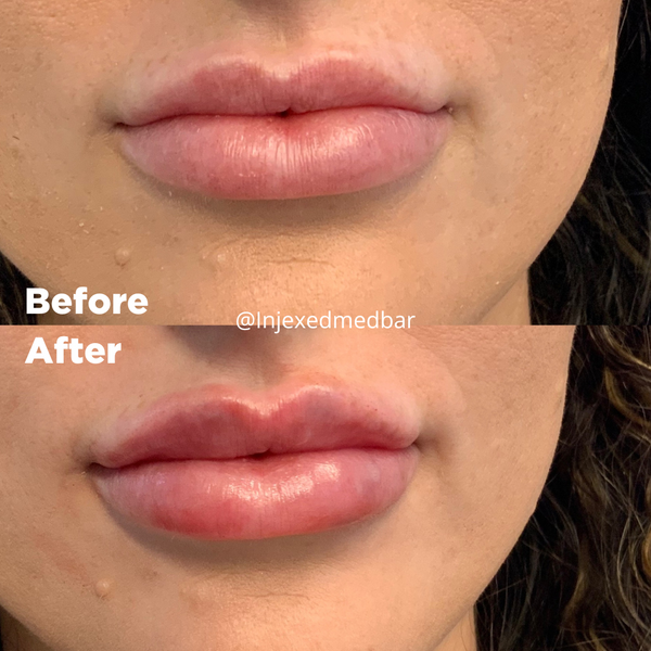 Lip Filler (2).png