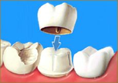 dental crowns and bridges