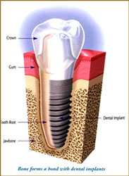 Smile Ranch Dentistry - Dental Implants dental implants
