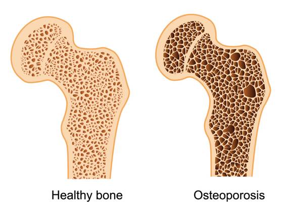 Osteoporosis-hip-image.jpg