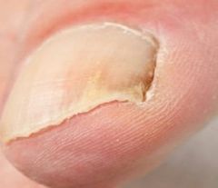 Nail Fungus