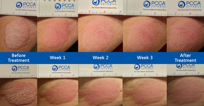 Before and after views of silicone gel treatment in scar management.