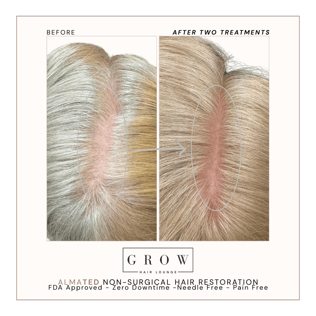 Top Shedding Improvement – AlmaTED Hair Restoration