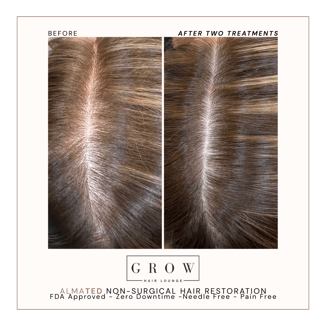 Hairline Restoration – Side Profile Before and After
