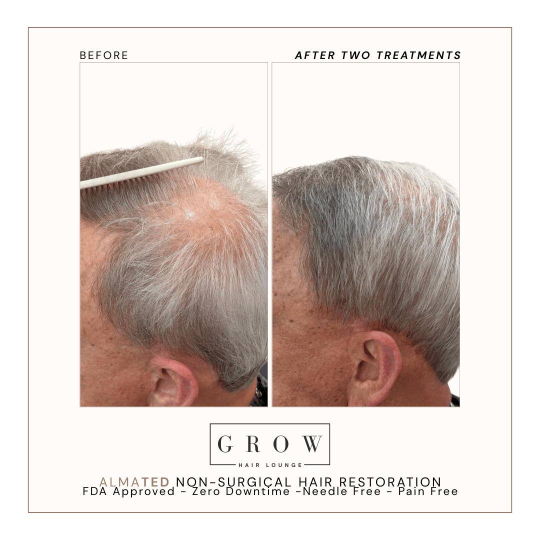 AlmaTED Hair Regrowth – Crown Area Before and After
