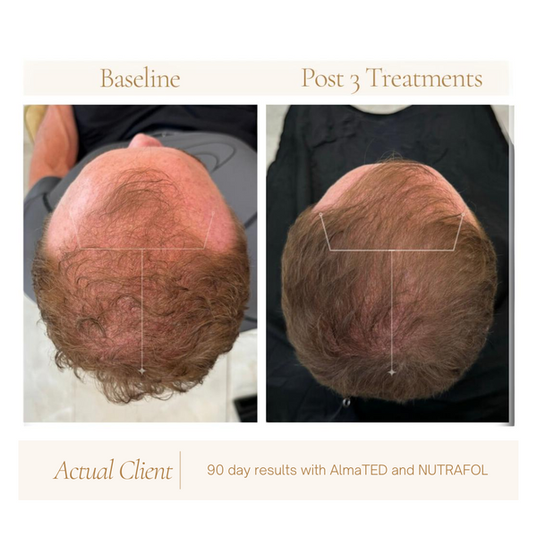 Before and after photo of AlmaTED Hair Restoration