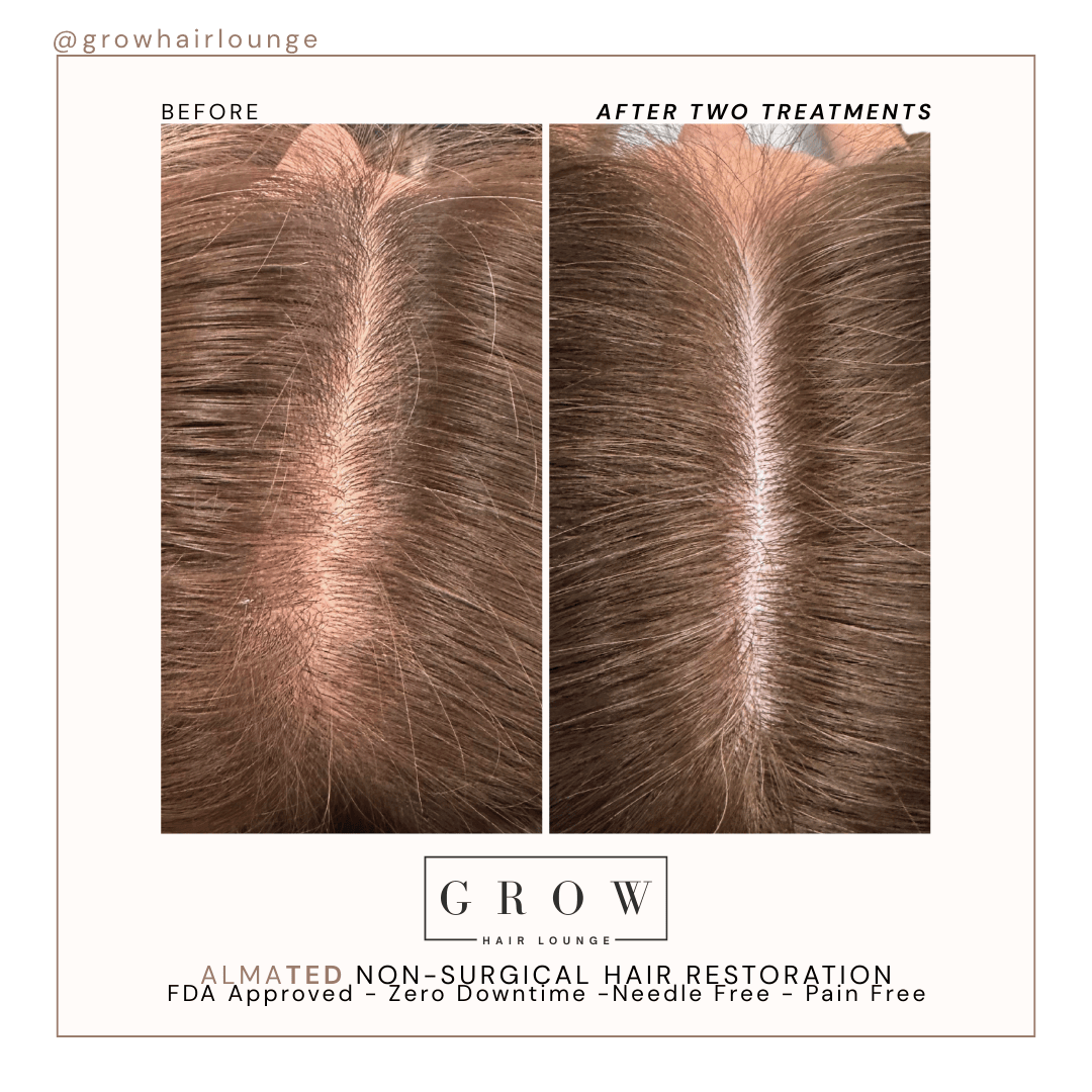 Diffuse Hair Thinning Before and After AlmaTED