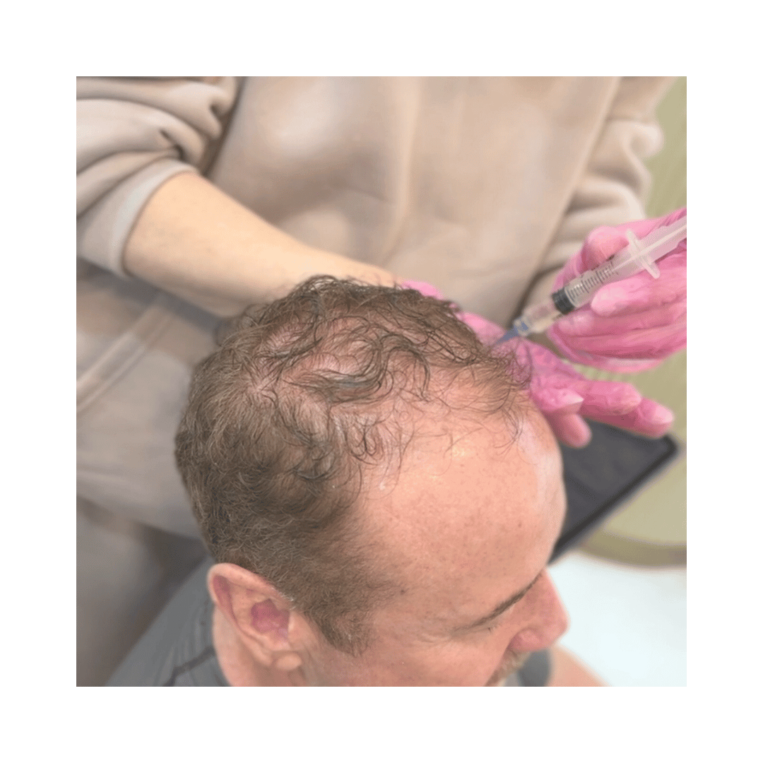 Pain-Free Alma TED Hair Restoration Atlanta (1).png