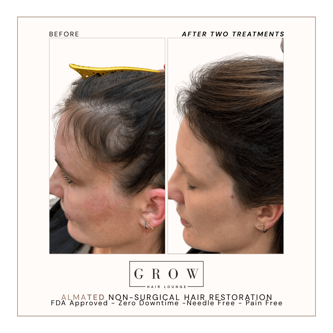 Hair Density Before and After AlmaTED Treatment – Vertex