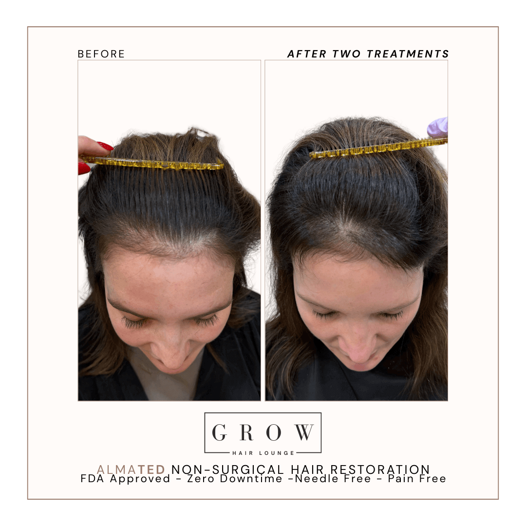 Hair Restoration Results – 3 AlmaTED Sessions