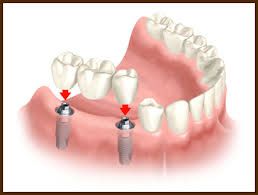 implant bridge implant bridge.jpg