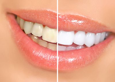 Teeth Whitening Austin Texas