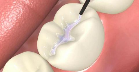 Sealants Sealants