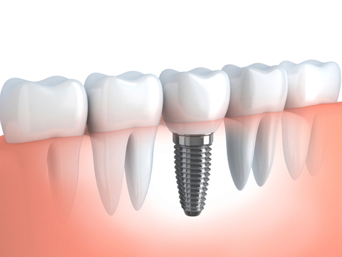 Tooth Replacement Austin Tooth Replacement Austin