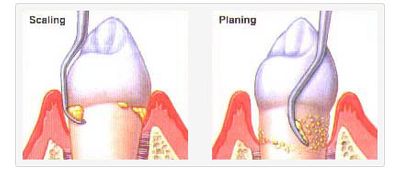 Scaling & Root Planing