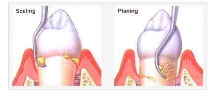 scaling and root planing scaling and root planing.jpg