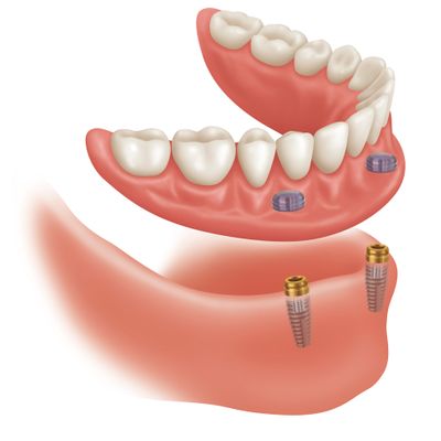 Implant Supported Dentures