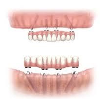 Dentures Austin Dentures Austin