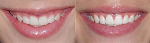 Crown Lengthening Crown Lengthening.jpg