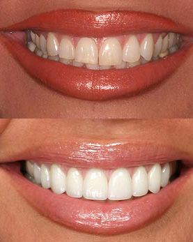 Porcelain Veneers Austin