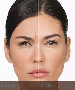 BOTOX-before-and-after-2-Hidden-Door-Medspa-Southlake.jpg