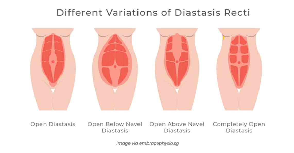 enhanced_diastasis.png