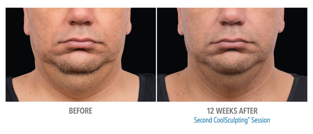 Male Submentum, Dr. Burns.jpg