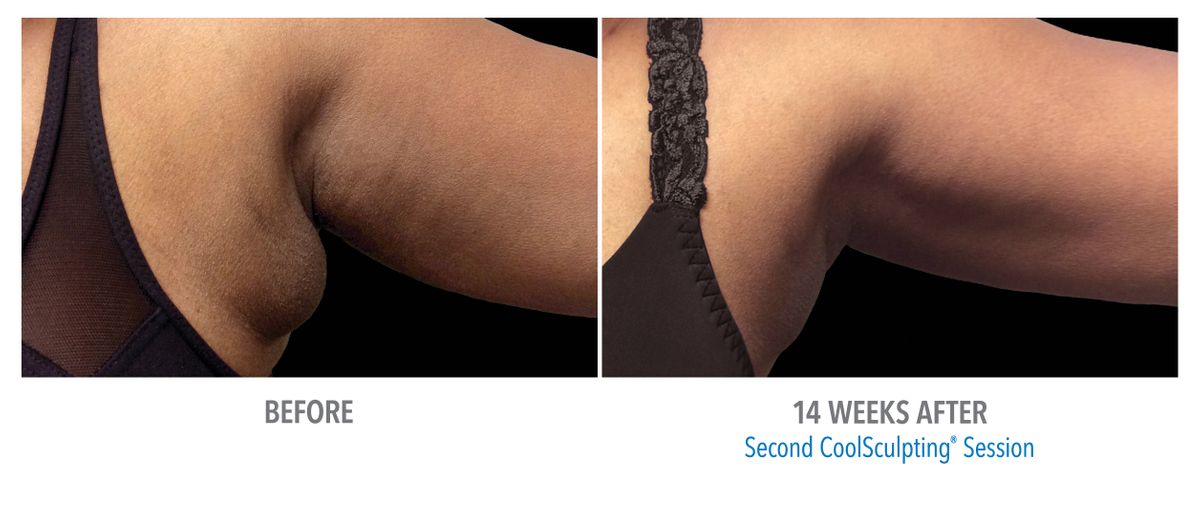 Female Bra Fat, Photo Courtesy of Honet Dermatology Cosmetic.jpg