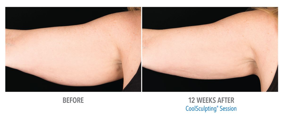 Female Arms, Photo Courtesy of Drs. Carruthers and Humphrey3.jpg