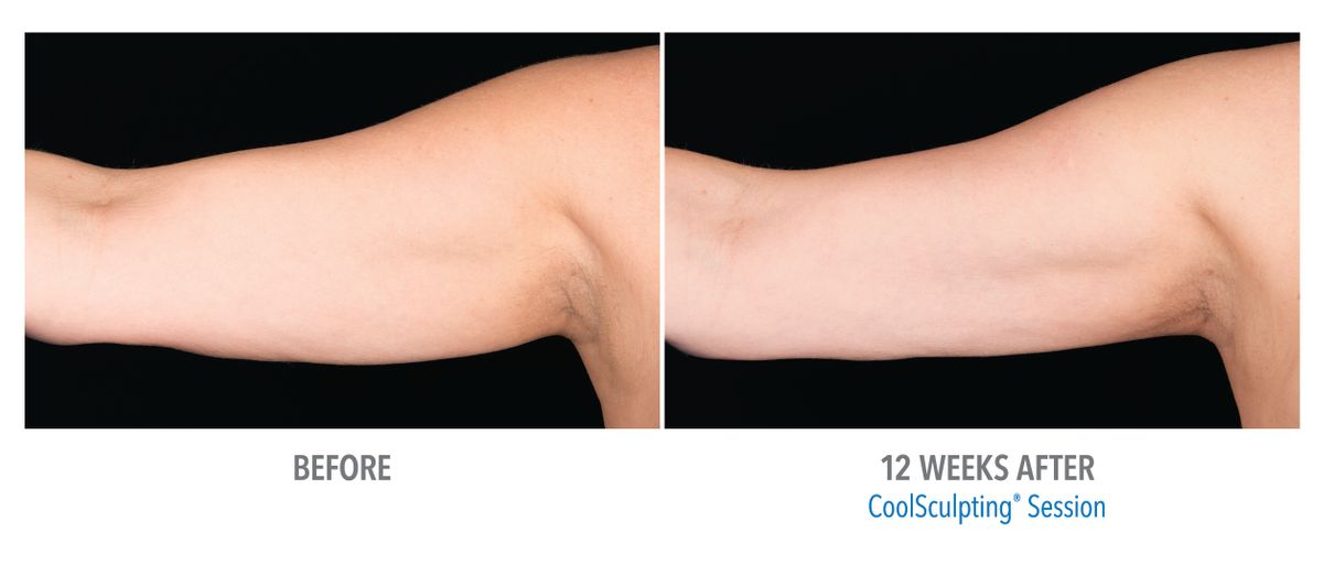 Female Arms, Photo Courtesy of Drs. Carruthers and Humphrey.jpg