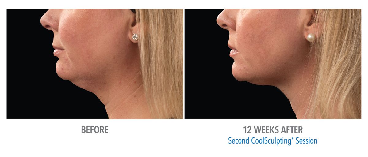 Female Submentum, Photo Courtesy of Dr. Kilmer_medium2.jpg