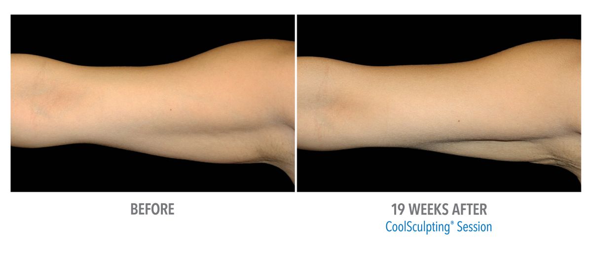 Female Arms, Premiere Plastic Surgery_large.jpg