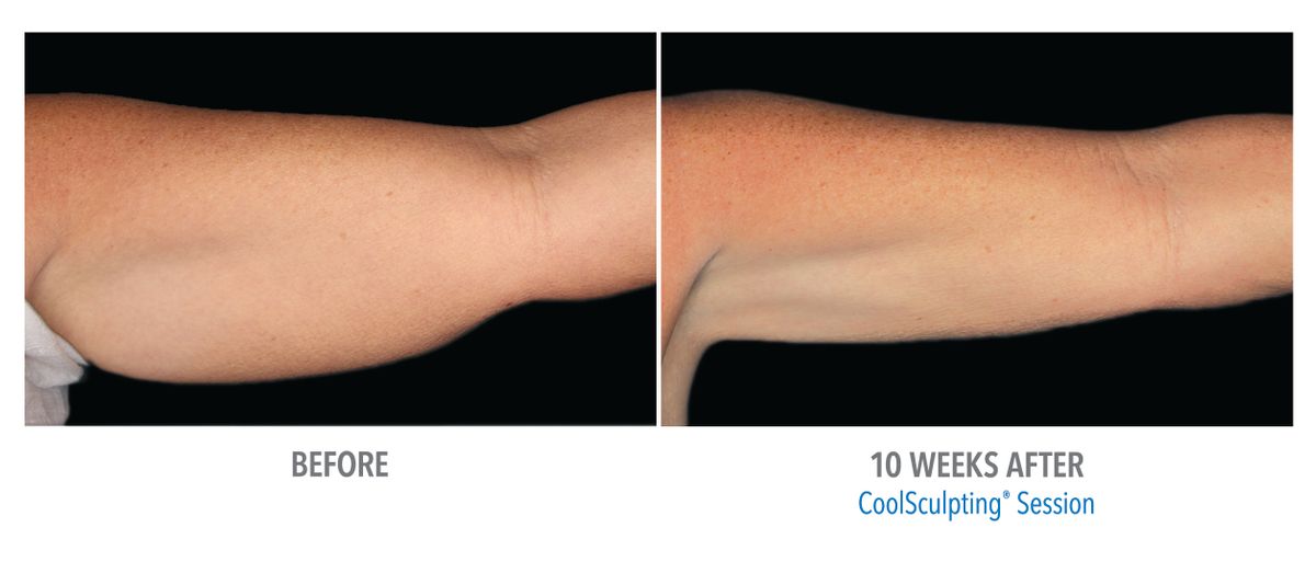 Female Arms, Photo Courtesy of Dr. Dawes_large.jpg