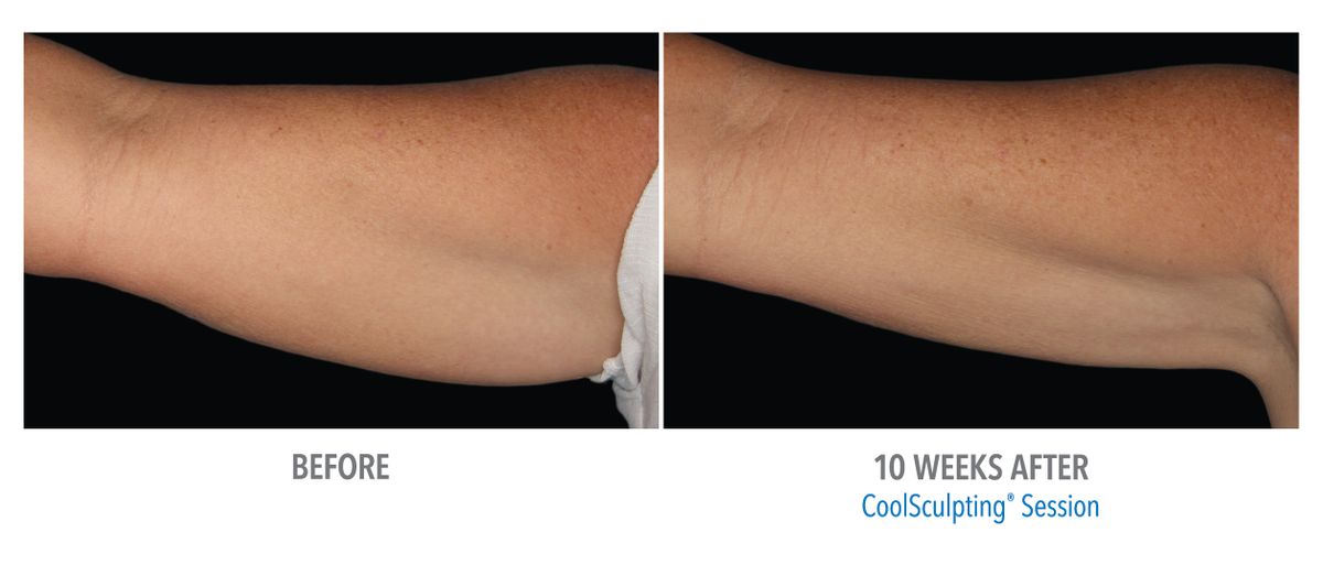 Female Arms, Photo Courtesy of Dr. Dawes_large2.jpg